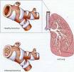 KAPSUL HERBAL BRONCHITIS