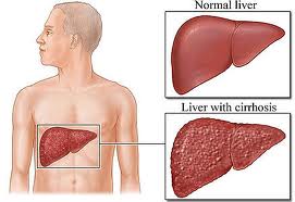 Hepatitis B Kronis