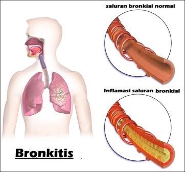 obat bronkitis akut