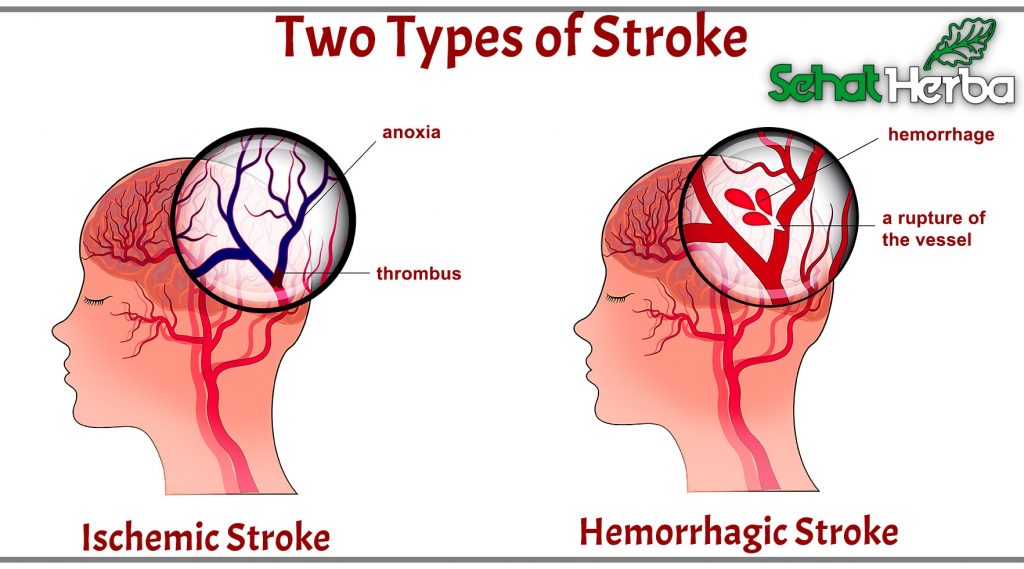 nastro obat herbal stroke